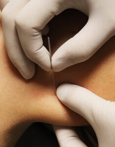 dry-needling