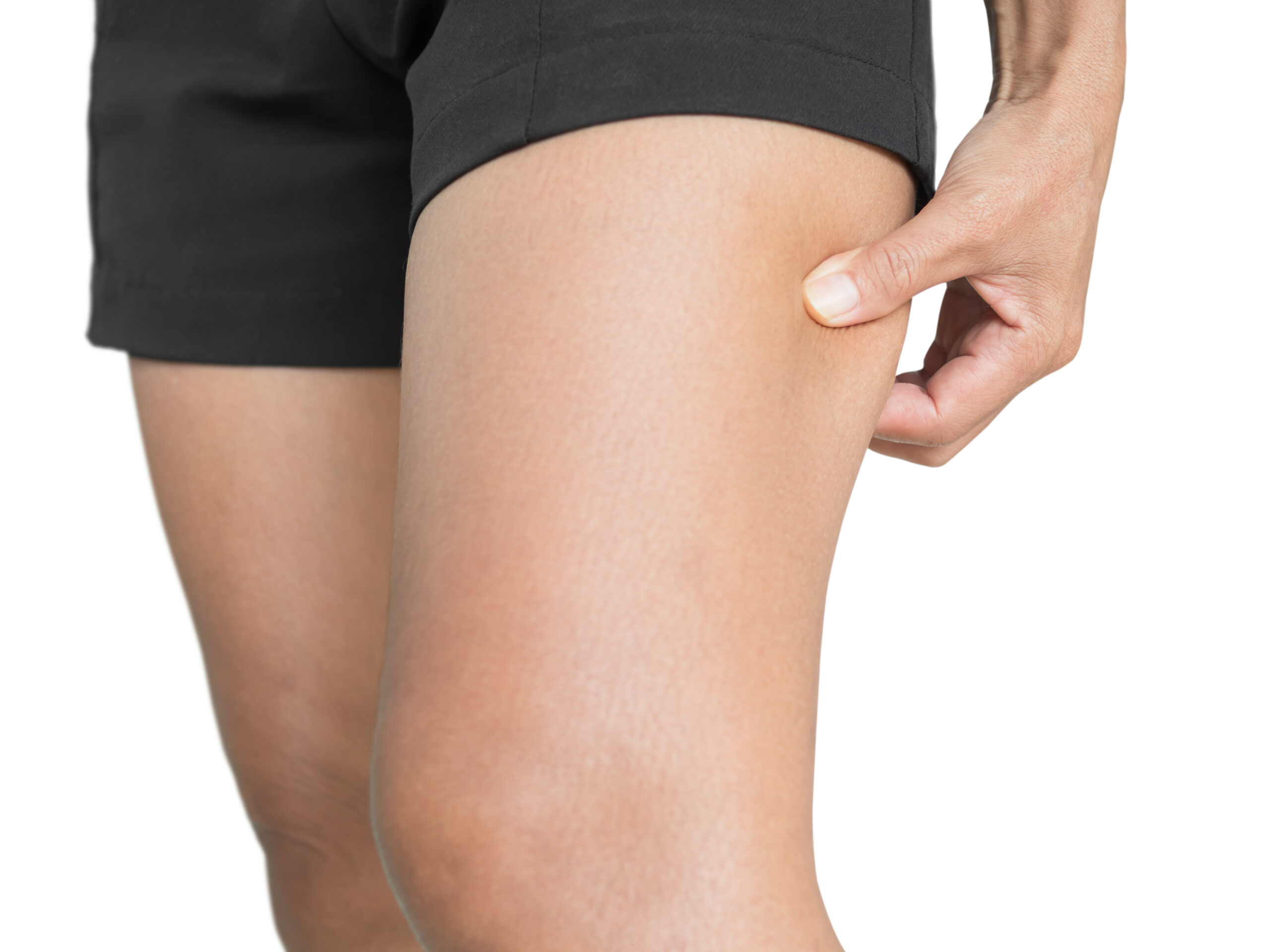 Body Diet Shape Slim Perfect Woman she Lifting Layer Cellulite Orange Peel on Thigh Leg Skin tan on white background, Young non fat for Treatment Massage Liposuction Obese Weight Care Concept.