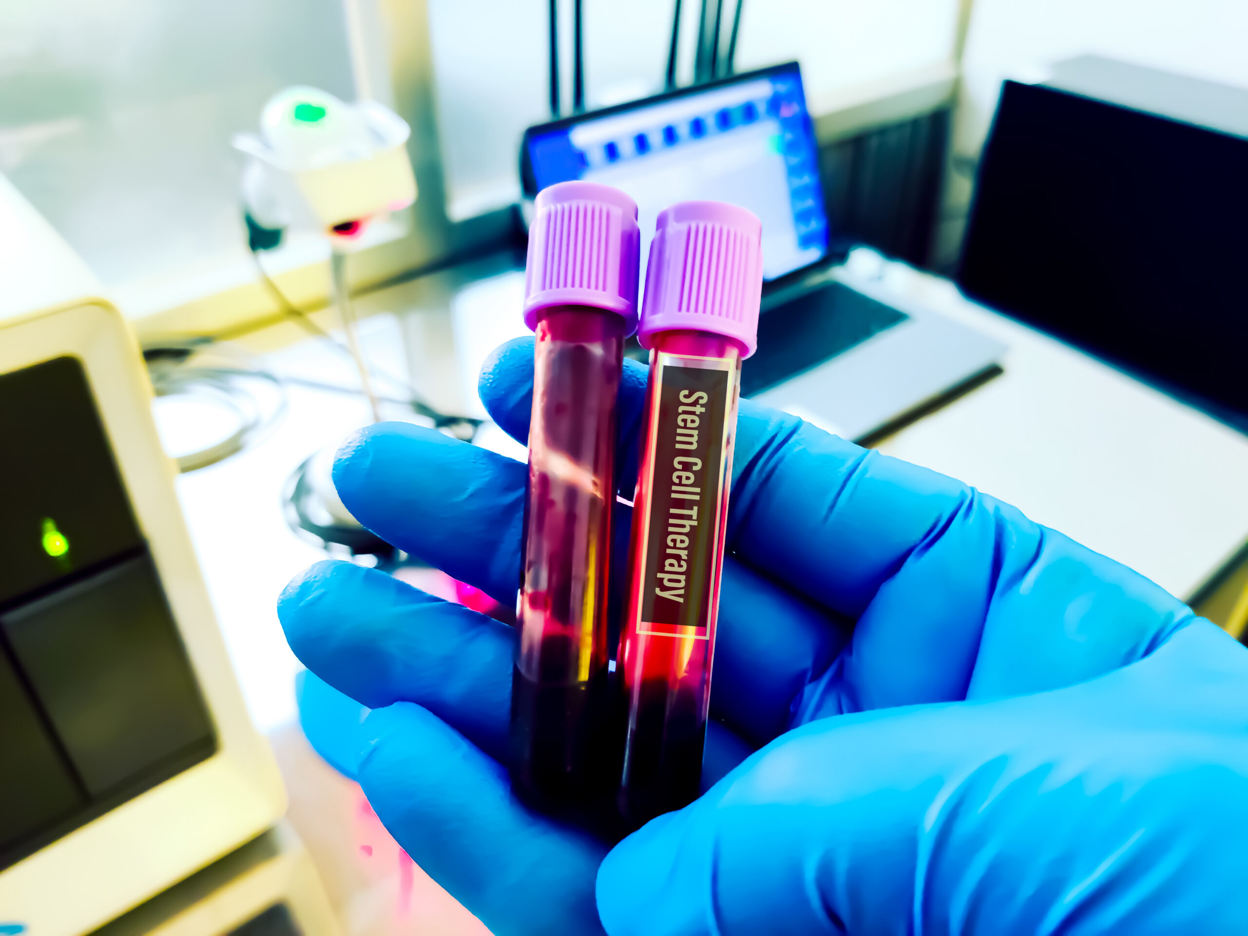 Blood sample for cell therapy testing. Several studies have shown that using stem cell therapy can be a treatment option for type 2 diabetes mellites.