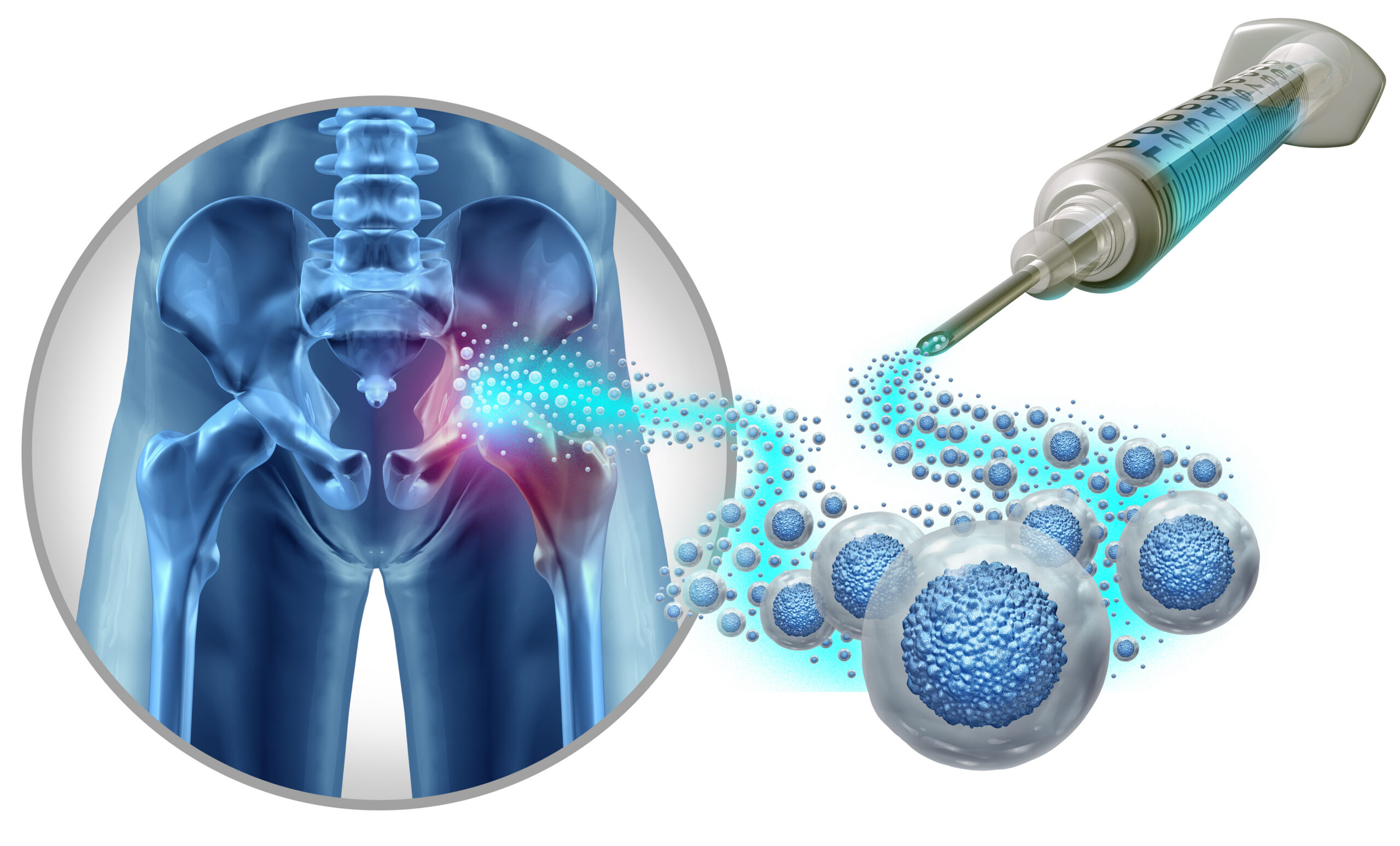 Hip Stem Cell Therapy and coxal joint regenerative therapies or hips treatment as restorative Medicine and Mesenchymal Stem Cells injected for pain to regenerate tissue repair.