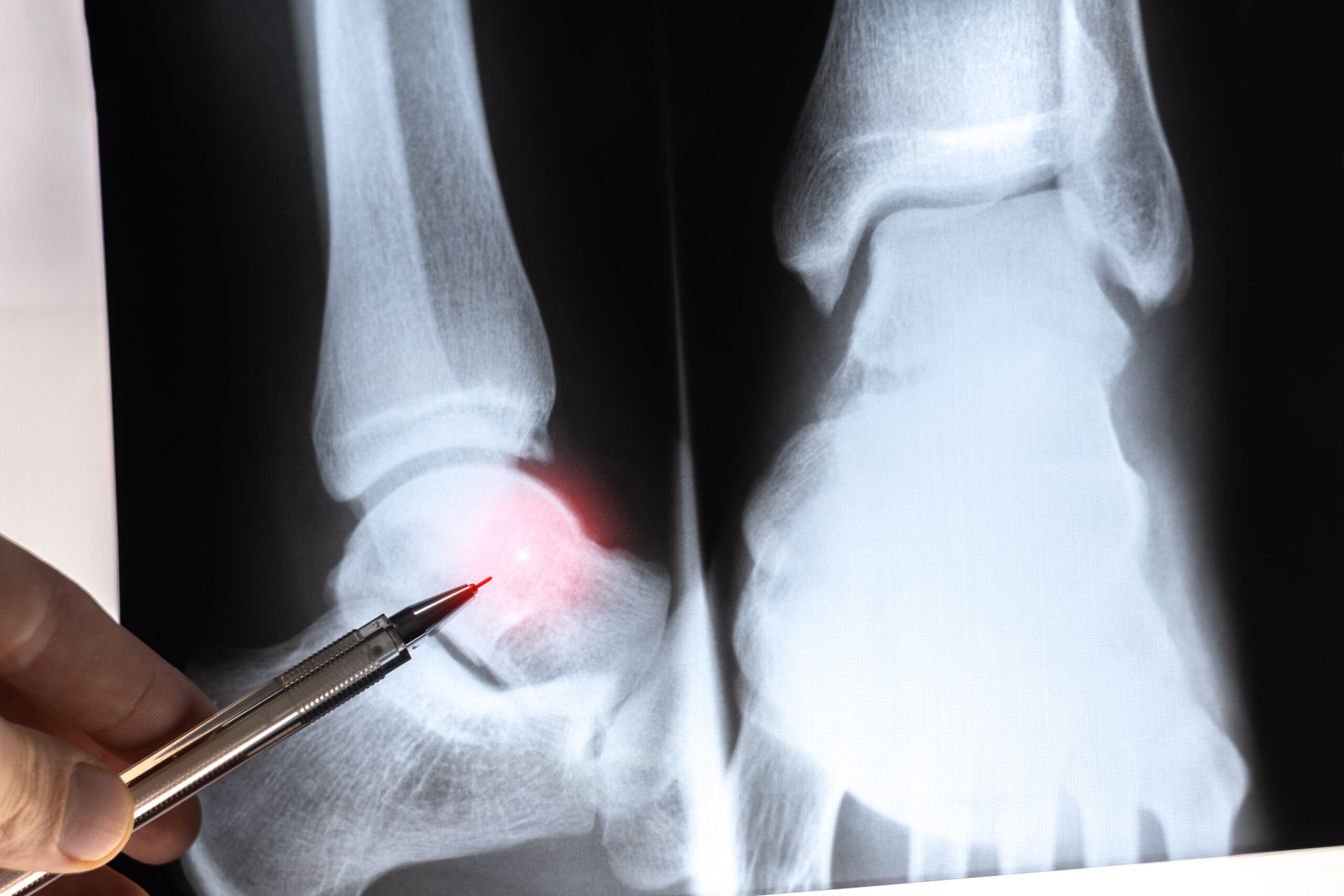 Doctor learning Medical X-ray with sprain and rupture of ankle ligaments.